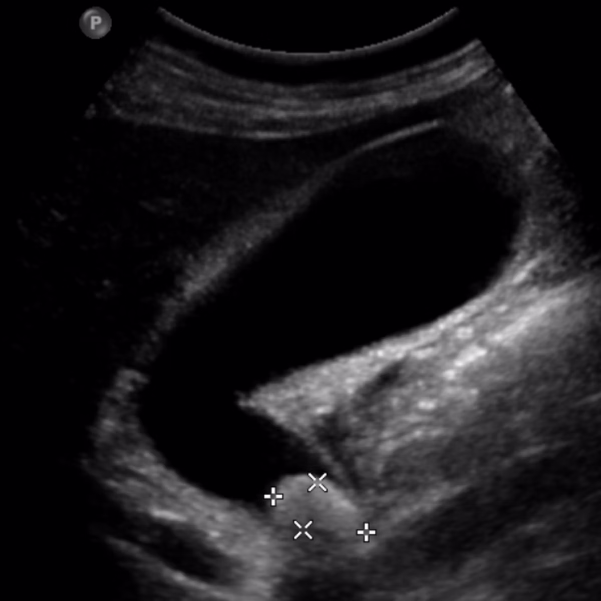 Sample case from Abdo Ultrasound