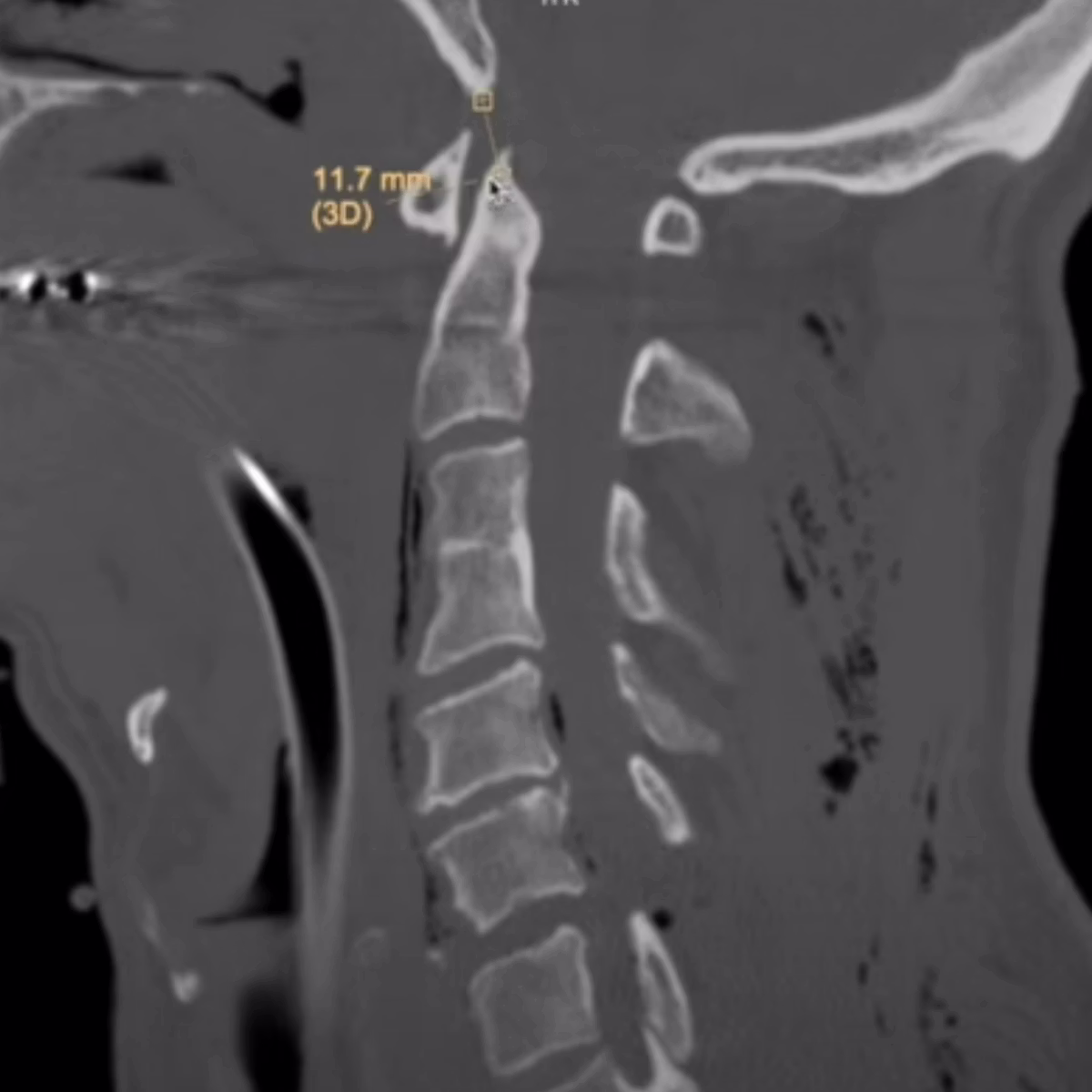 Sample case from CT Cervical Spine