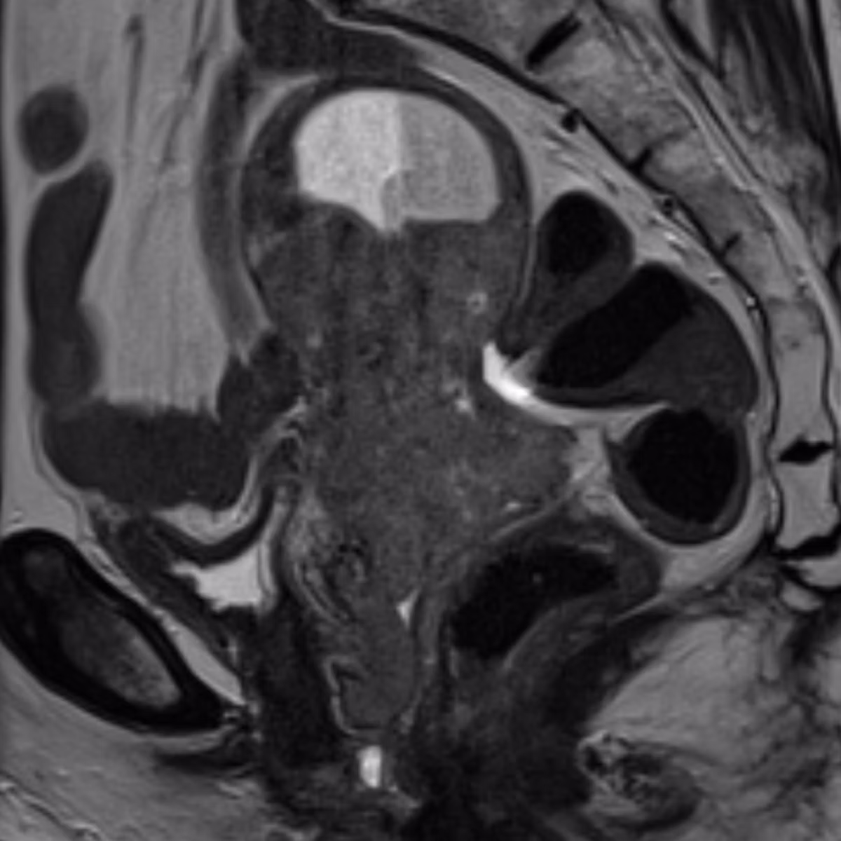 Sample case from Gyne MRI