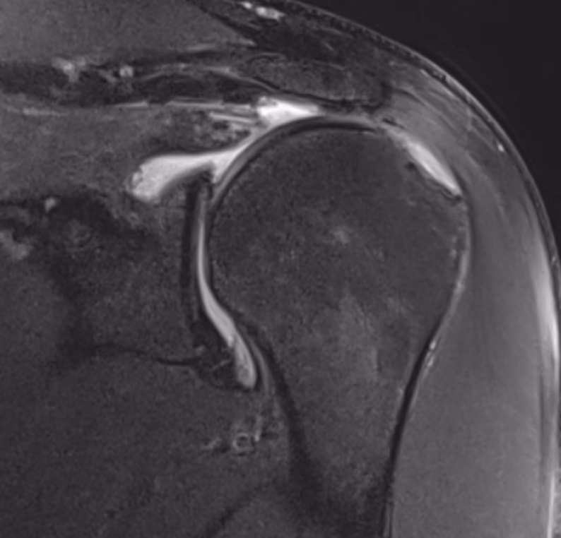 Sample case from Shoulder MRI